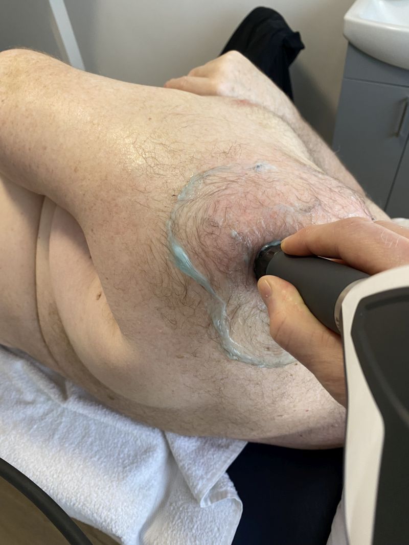Shockwave therapy treatment