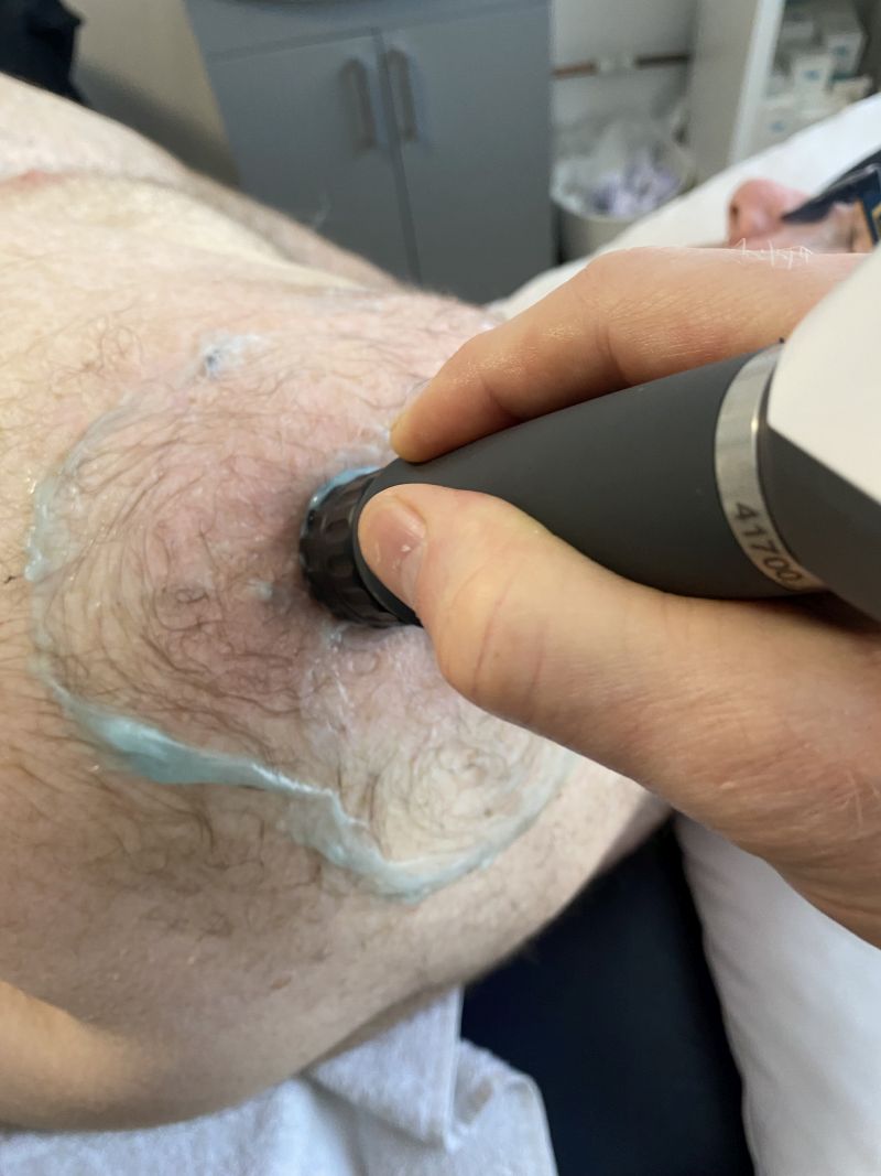 Shockwave therapy treatment