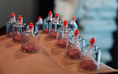 Cupping