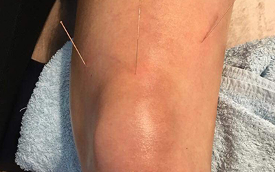 Dry Needling